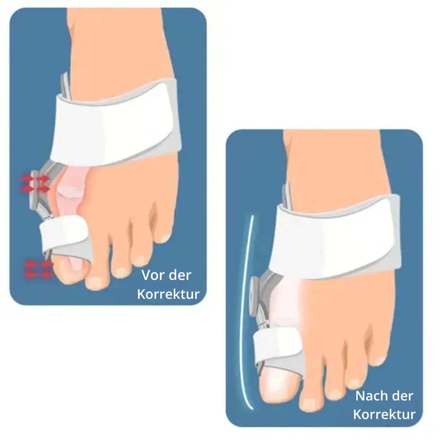 Hallux Valgus Korrekturbandage